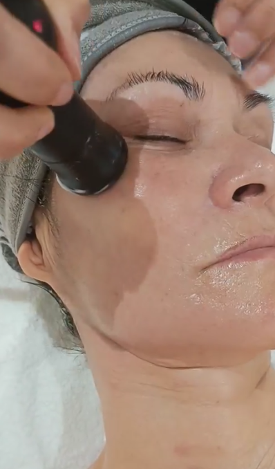 Radiofrecuencia facial